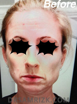 female before Facelift - picture