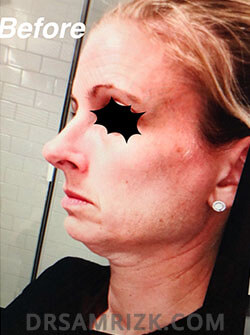 female before Facelift - picture