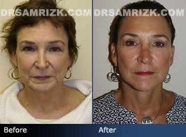 Female facelift before & after - pics