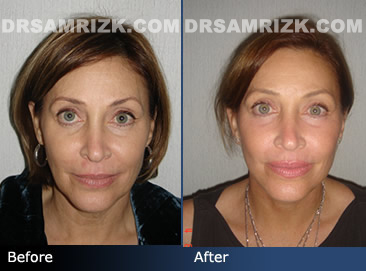 Woman's face, Before and after facelift treatment, front view