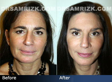 Facial Plastic Surgery before and after images