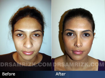 Female ethnic rhinoplasty before & after photos