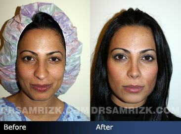 revision rhinoplasty before & after - images