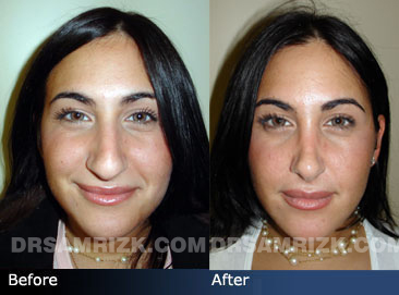 Female patient rhinoplasty before & after - images