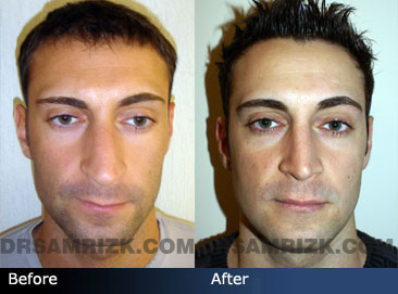 photos male before and after Rhinoplasty