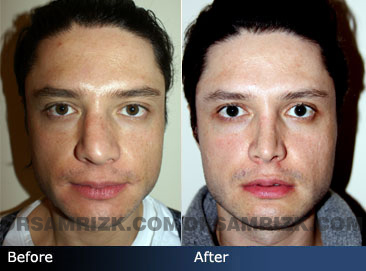 Male face, Before and After Rhinoplasty Treatment, nose, front view, patient 1