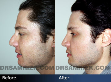 Male face, Before and After Rhinoplasty Treatment, nose, left side view, patient 1