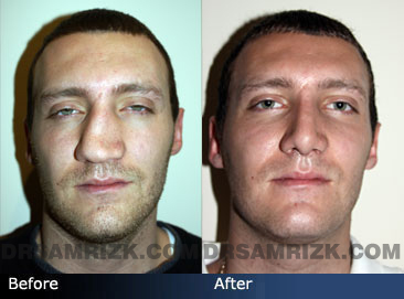 non-surgical rhinoplasty before and after - images