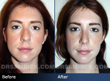 patient before and after septoplasty - images