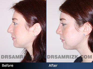 septoplasty before & after photos