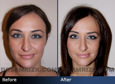 front images before and after teen rhinoplasty