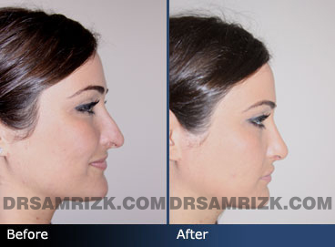 Rhinoplasty Female before and after