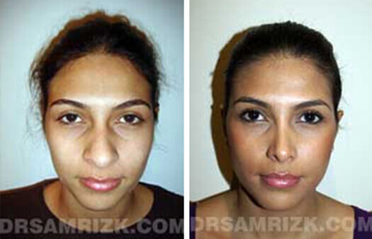 Female face, before and after Rhinoplasty treatment, front view, patient 4