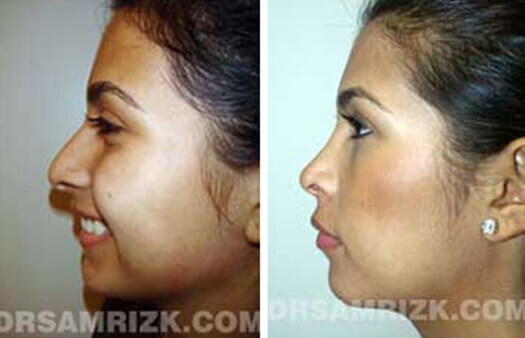 Female face, before and after Rhinoplasty treatment, side view, patient 4