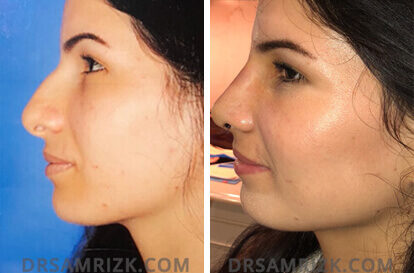 Female face, before and after Rhinoplasty treatment, l-side view, patient 11