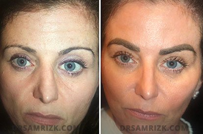 Female face, before and after Rhinoplasty treatment, front view, patient 12