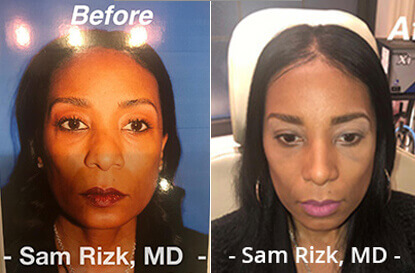 Female face, before and after Rhinoplasty treatment, front view, patient 6