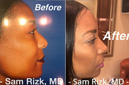 Female face, before and after Rhinoplasty treatment, side view, patient 6