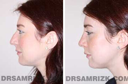 Female face, before and after Rhinoplasty treatment, side view, patient 3