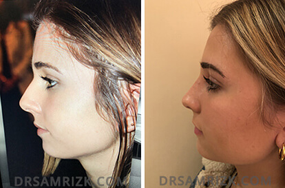 Female face, before and after Rhinoplasty treatment, side view, patient 8