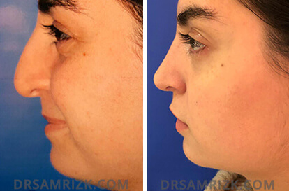 Female face, before and after Rhinoplasty treatment, l-side view, patient 9