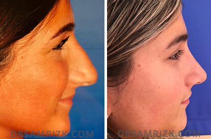Female face, before and after Rhinoplasty treatment, r-side view, patient 10