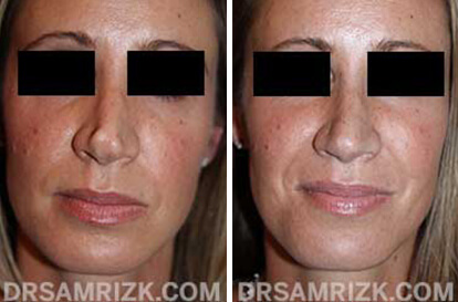 Patient 12 Set1 before and after rhinoplasty