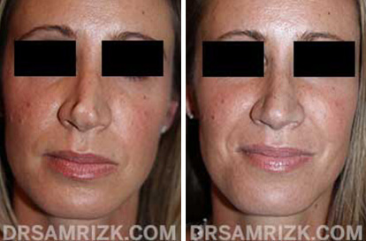 Female face, before and after Rhinoplasty treatment, front view, patient 5