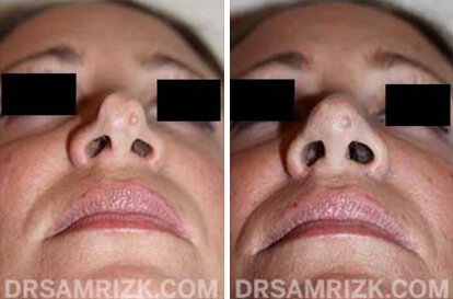 Female face, before and after Rhinoplasty treatment, below view, patient 5
