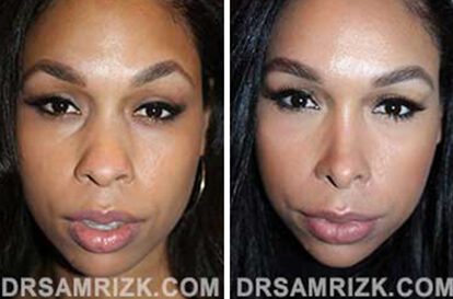 Female face, before and after Rhinoplasty treatment, front view, patient 2
