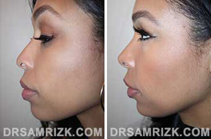 Female face, before and after Rhinoplasty treatment, side view, patient 2