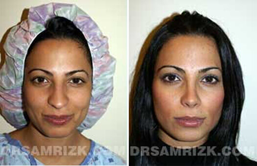 Woman's face, Before and After Rhinoplasty Treatment, front view, patient 1