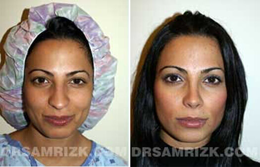 Female face, before and after Rhinoplasty treatment, front view, patient 1