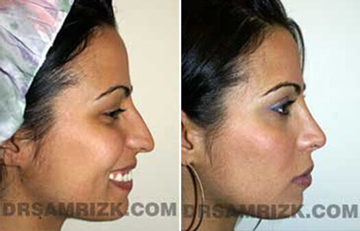 Female face, before and after Rhinoplasty treatment, side view, patient 1