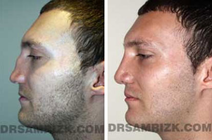Patient 6 Set1 before and after rhinoplasty