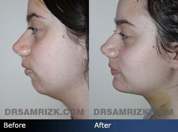 pics female patient before and after Rhytidectomy