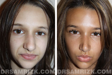 Patient 3 Set1 before and after rhinoplasty