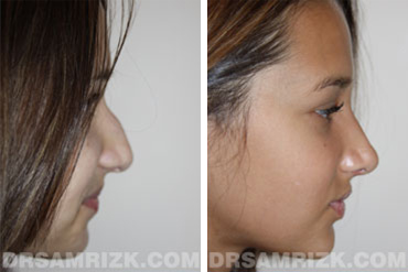 Patient 3 Set1 before and after rhinoplasty