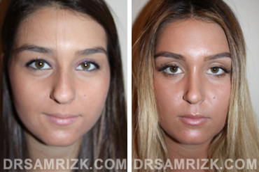 Patient 3 Set1 before and after rhinoplasty