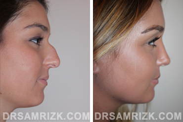 Patient 3 Set1 before and after rhinoplasty