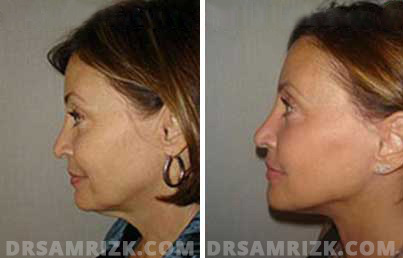 Galleries. Before and After Facelift/Necklift Treatment , woman's face, side view