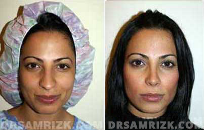 Galleries. Before and After Female Rhinoplasty Treatment , woman's face, front view