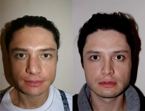 25 year old male who sustained a nasal fracture with deviation of nose to right who also requested removal of nasal bump and tip refinement. Patient is shown 1 year after rhinoplasty where the nose was straightened and the bump was removed but nose was also too short on profile and was elongated a few millimeters. Procedure was done with endonasal approach and a cartilage tip graft was placed to provide tip definition (harvested from patient’s own septum). Nose was also brought closer to face (deprojected).