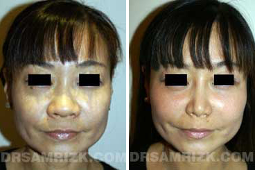 Ethnic rhinoplasty patient before and after photo