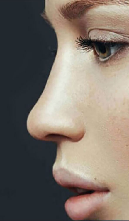 Best Revision Rhinoplasty in the World