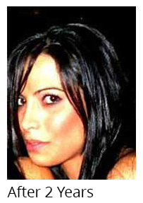 Female Patient after Nose Job
