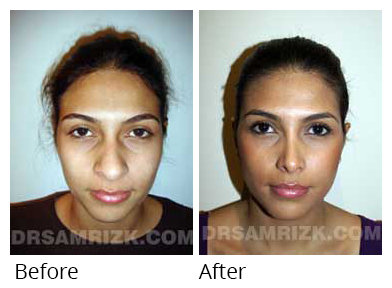 Latino Female Patient before after nostril reduction