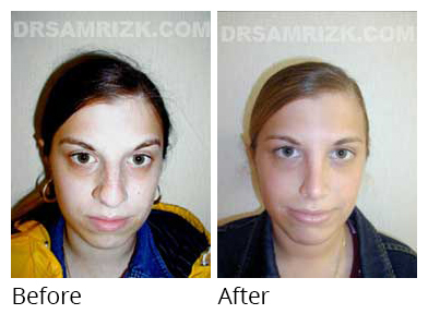 Patient before after chin implant and rhinoplasty