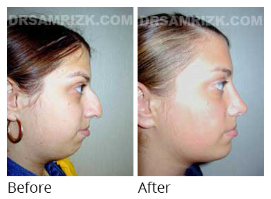 Female Patient before after chin implant and rhinoplasty