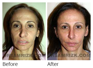 Patient before after Rhinoplasty